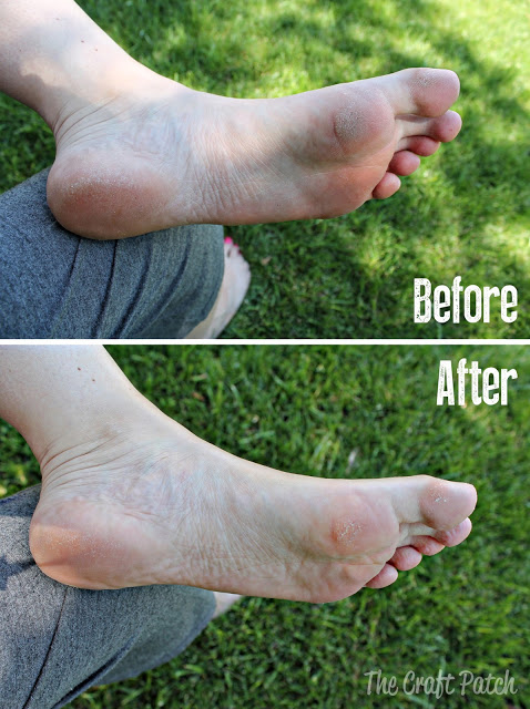 foot soak to remove dead skin vinegar